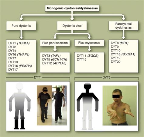 torsion dystonia gene testing|genetic testing for dystonia.